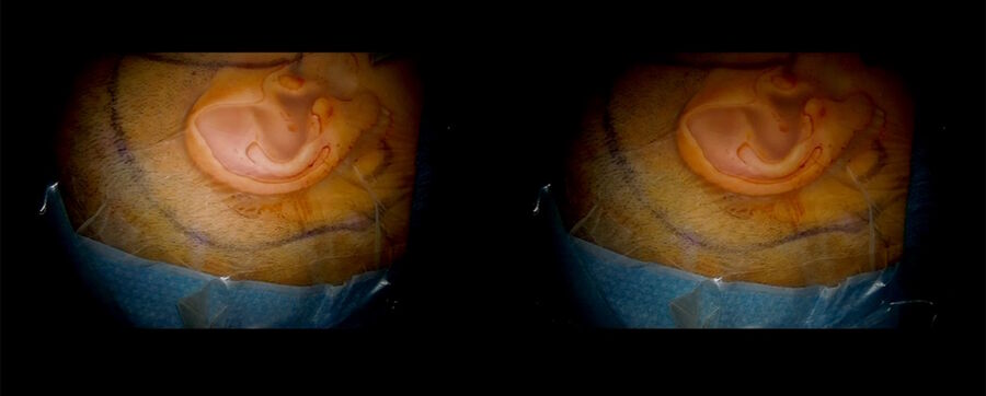 [Translate to chinese:] Combined petrosectomy 3D educational video. Image courtesy of Dr. Florian Bernard.