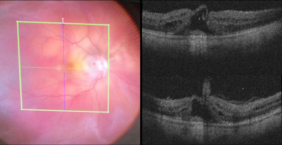 [Translate to chinese:] Vitrectomy for macular hole. The intraoperative OCT view shows the good position of the ILM flap covering the hole.