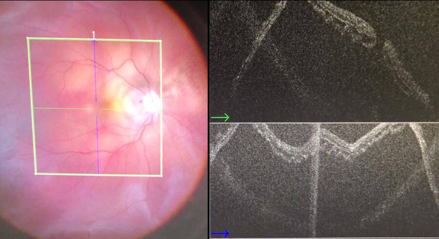 [Translate to chinese:] Retinal detachment with a macular hole in a highly myopic eye. Intraoperative OCT confirms the presence and location of the macular hole.
