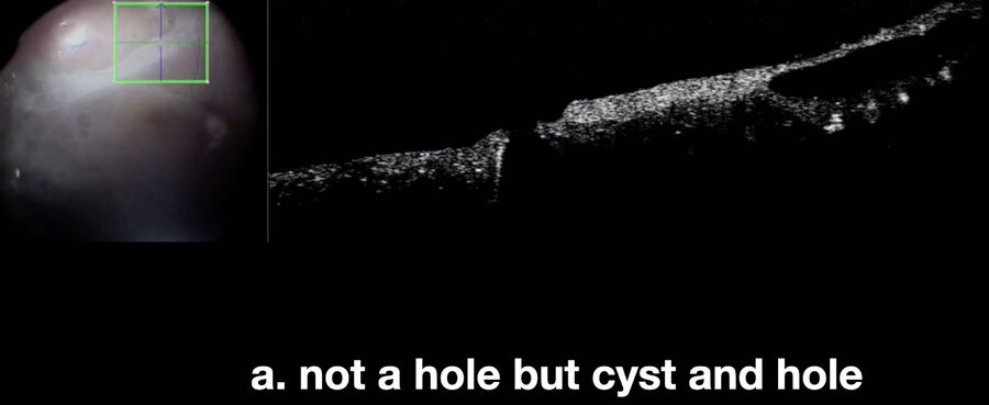 [Translate to chinese:] Intraoperative OCT shows that point “a” is a cyst located in close proximity to a hole.