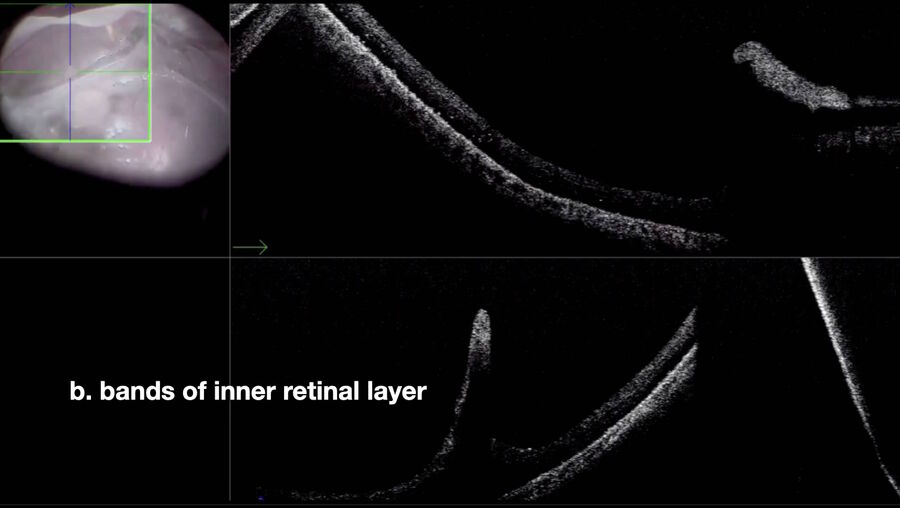 [Translate to chinese:] OCT shows that point “b” are bands of the inner retinal layer.