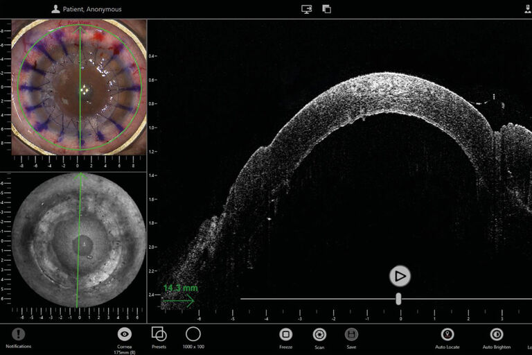 EnFocus 术中光学相干断层扫描成像 (OCT) 系统的 InVivo 软件，以四分屏视图显示角膜手术。查看左上角的显微镜图像、左下角的正面视图以及右侧的光学相干断层扫描成像 (OCT) B 超图像。
