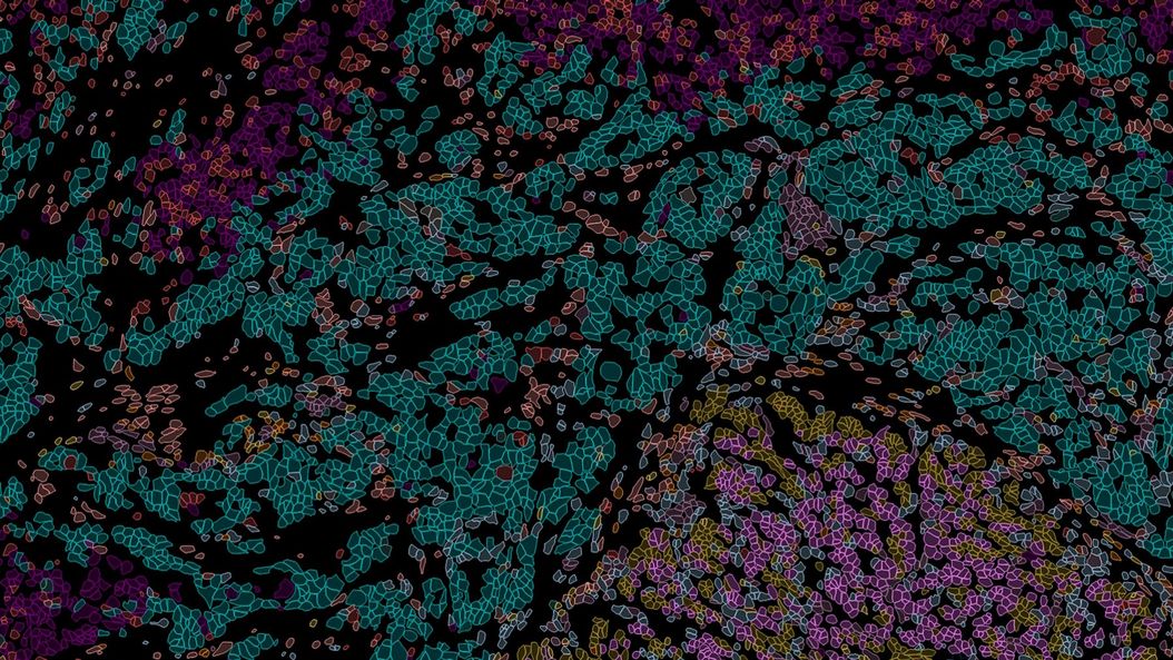 使用 Cell DIVE 对胰腺导管腺癌进行成像。分析由 Aivia 完成。 Pancreatic_Ductal_Adenocarcinoma_Cell_DIVE_with_analysis_by_Aivia.jpg