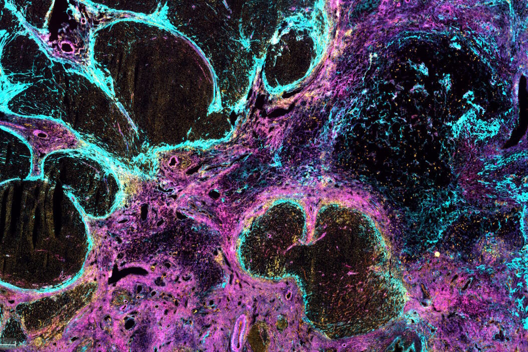 [Translate to chinese:] Co-detection of 10 extracellular matrix proteins and 3 topographical tissue landmarks by multiplex immunostaining within a single high-grade fibrous hotspot from a human hepatocellular carcinoma Single_high-grade_fibrous_hotspot_from_a_human_hepatocellular_carcinoma.jpg