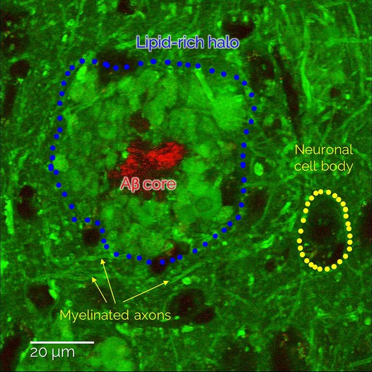 Placas amiloide-β y depósitos lipídicos patológicos asociados visualizados en tejidos cerebrales no teñidos. El análisis espectroscópico muestra un enriquecimiento de los lípidos de la membrana y una reducción del colesterol en comparación con las estructuras cerebrales sanas cercanas, lo que proporciona una nueva ventana para estudiar las conexiones entre el metabolismo de los lípidos y la patología del Alzheimer. Muestra por cortesía del Dr. Martin Fuhrmann, Andrea Baral, Centro Alemán de Enfermedades Neurodegenerativas, Bonn.