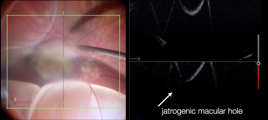 [Translate to chinese:] Intraoperative OCT shows an iatrogenically induced macular hole, while detaching the retina with subretinal injection of a balanced salt solution (BSS).