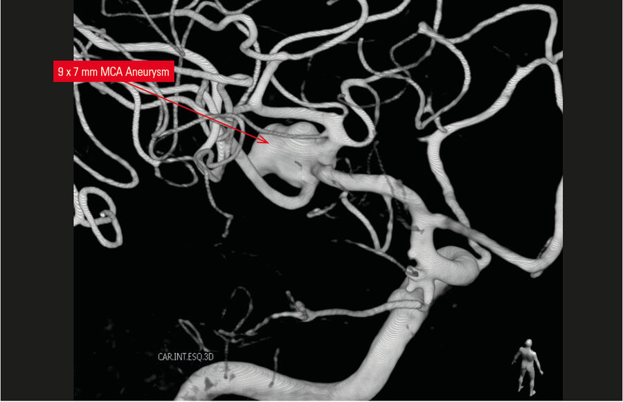 3D reconstruction showing the MCA aneurysm.