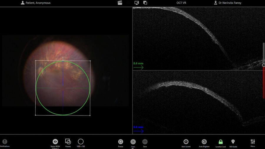  Figure 6: Dr. Nerinckx utilizes the foot pedal to move and control the OCT scan after injection to check for foveal stretching and confirm there is no macular hole.