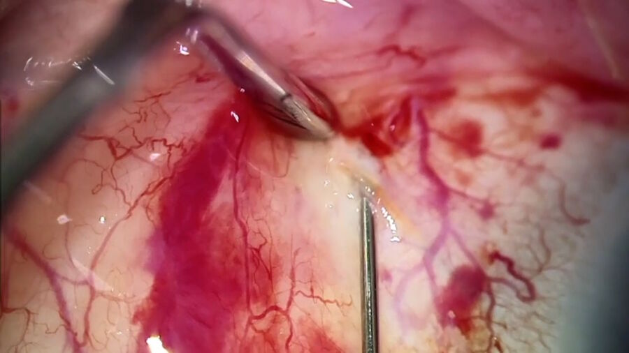 [Translate to chinese:] Examination of old subconjunctival stent after peritomy revealed surrounding Tenon's tissue. Image courtesy of Arsham Sheybani, MD, Washington University School of Medicine.