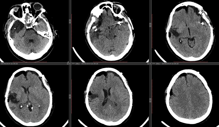 CT showing clip positions.