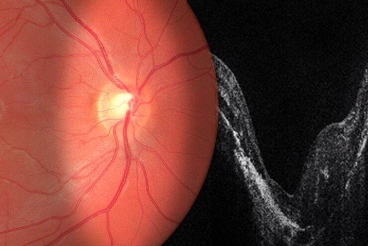 OCT-Guided Retina Surgery