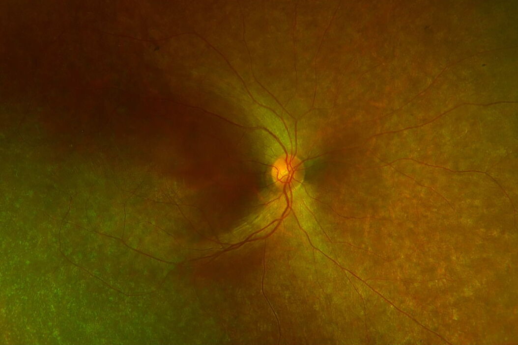 Diffuse retinal degeneration with relative macular sparing. Typical_diffuse_retinal_degeneration_with_relative_macular_sparing.jpg