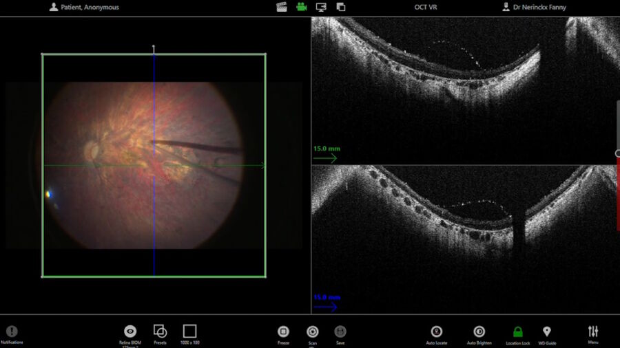 Figure 3: The intraoperative OCT shows the vitreoschisis.