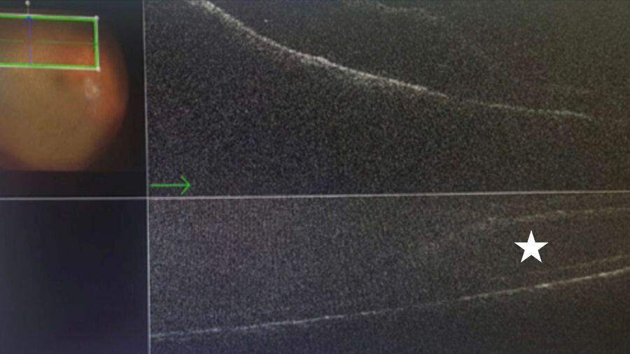 [Translate to chinese:] Intraoperative OCT view confirming that a suspect retinal detachment is, in fact, an area of retinoschisis (represented by the asterisk).