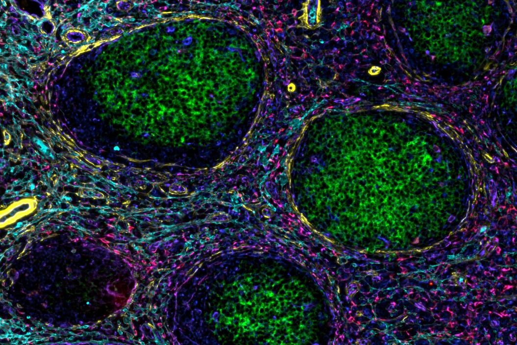 Cell DIVE image of stromal remodeling around B cell follicles of follicular lymphoma patients. Stromal cells labeled with antibodies against desmin (red), SPARC (orange), vimentin (blue), and a-sma (yellow). Extracellular matrix labeled with antibody against lumican (cyan). B cells labeled with antibody against CD20 (green). Image credit: Dr. Andrea Radtke, Center for Advanced Tissue Imaging, NIAID, NIH Stromal_remodeling_around_B_cell_follicles_of_follicular_lymphoma_patients.jpg