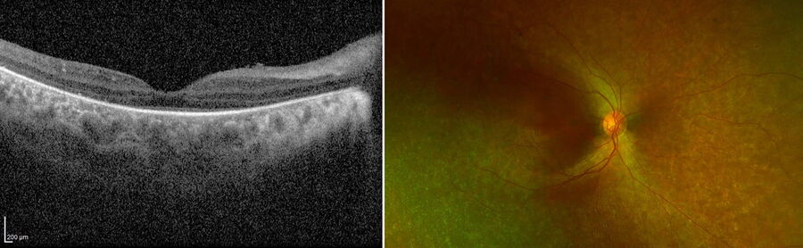 [Translate to chinese:] The macular OCT and ultra-wide field fundus images showed baseline pigmentary retinopathy and photoreceptor alterations relatively sparing the fovea. Images provided by Robert A. Sisk, MD, FACS.