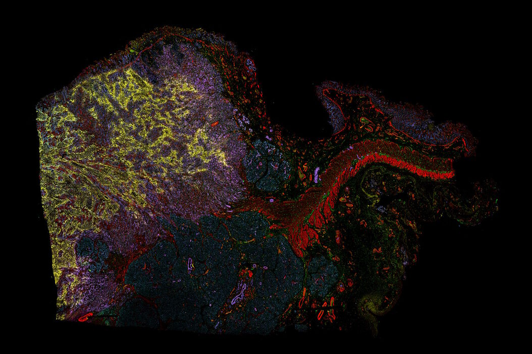 [Translate to chinese:] Pancreatic Ductal Adenocarcinoma with 5 biomarkers shown – SMA, PanCK PCK26, PanCK AE1, Vimentin, and Glut1. Pancreatic_Ductal_Adenocarcinoma_with_5_biomarkers.jpg