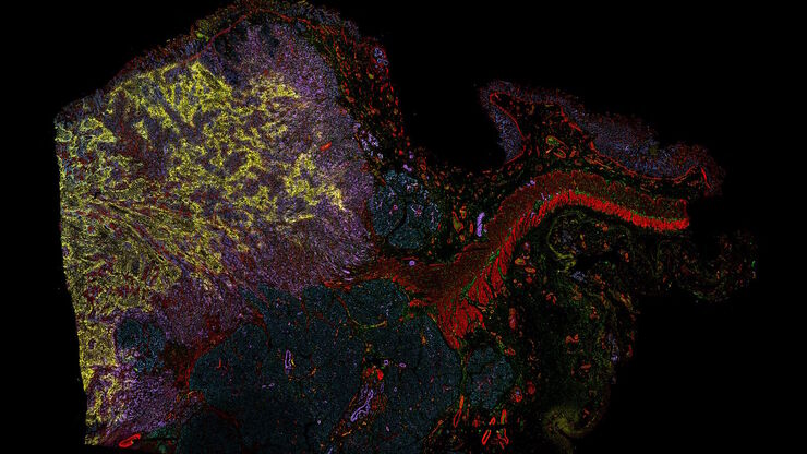 [Translate to chinese:] Pancreatic Ductal Adenocarcinoma with 5 biomarkers shown – SMA, PanCK PCK26, PanCK AE1, Vimentin, and Glut1.