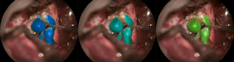 Images courtesy of Cleopatra Charalampaki, MD, PhD, Professor of Neurosurgery, Department of Neurosurgery, Cologne Medical Center, Germany.