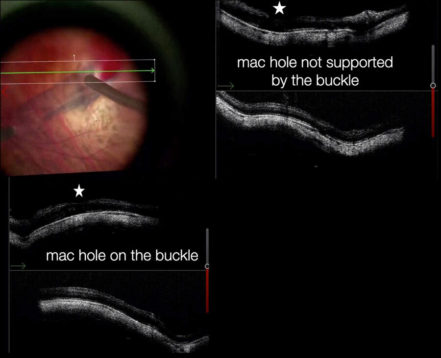 [Translate to chinese:] Intraoperative visualization provides a detailed confirmation of the buckle position and of the macular hole on the top right, which is NOT well positioned on the buckle