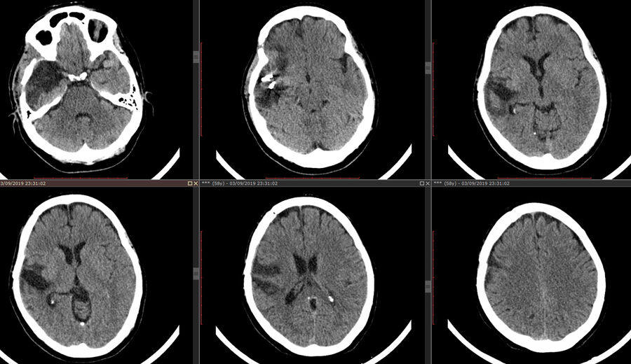 CT after first surgery