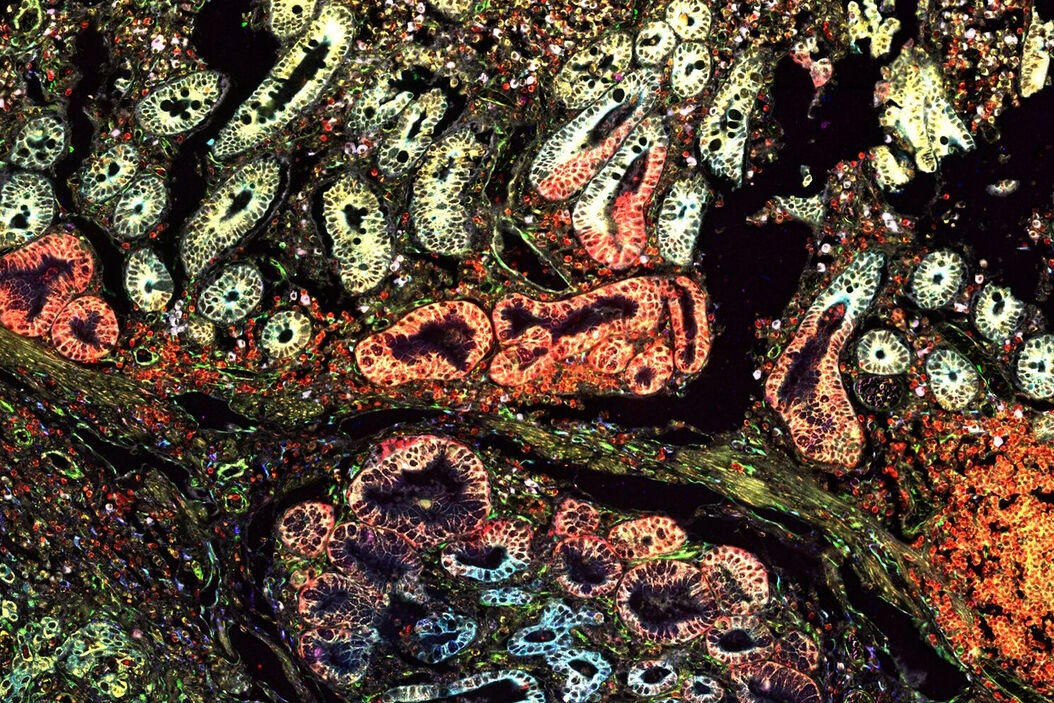 Pancreatic Ductal Adenocarcinoma with 11 Apoptosis biomarkers shown – BAK, BAX, BCL2, BCLXL, Caspase9, CIAP1, NaKATPase, PCK26, SMAC, Vimentin, and XIAP. Pancreatic_Ductal_Adenocarcinoma_11_Apoptosis_Markers_ROI5.jpg