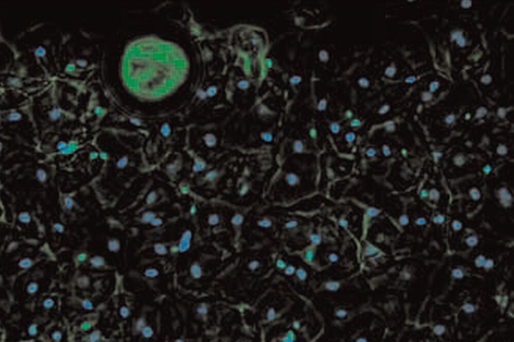 SPERM HY-LITER™ staining of a sexual assault smear slide performed by forensic DNA crime laboratory. SPERM_HY-LITER_staining_of_sexual_assault_smear_slide-dual_DAPI_FITC_cubes.jpg