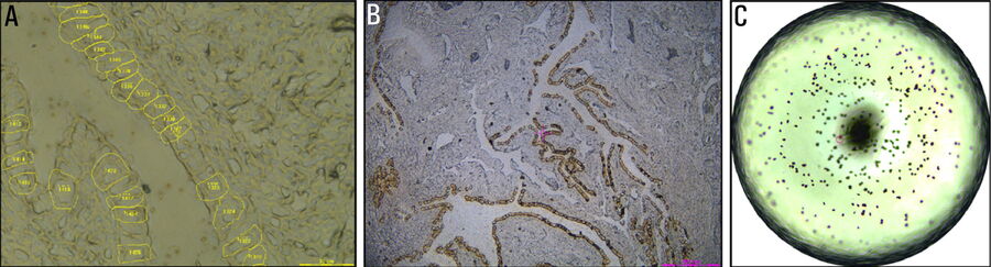 A) Contour alignment in the LMD7 software before laser microdissection of fallopian tube epithelial cells. B) Screenshot after laser microdissection. C) 384-well inspection after laser microdissection in individual fallopian tube epithelial cells.