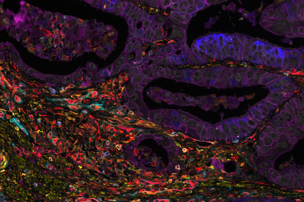 Colon adenocarcinoma with 13 biomarkers shown Colon_adenocarcinoma_with_13_biomarkers_shown.jpg