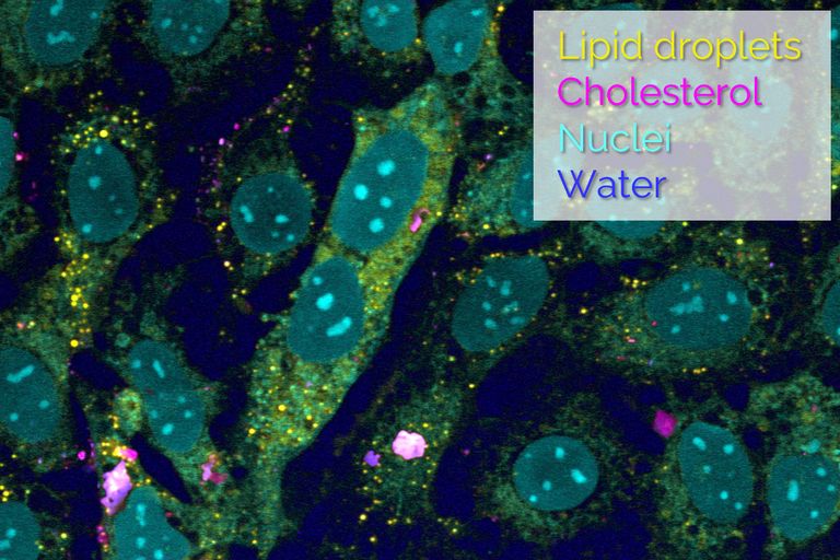 SRS光谱扫描(2800-3100 cm⁻¹,38个光谱点)对二维细胞培养物(补充胆固醇的U2OS细胞)的解混结果,显示脂滴(黄色)、胆固醇沉积(洋红色)、细胞核(青色)及水相缓冲液(蓝色)。