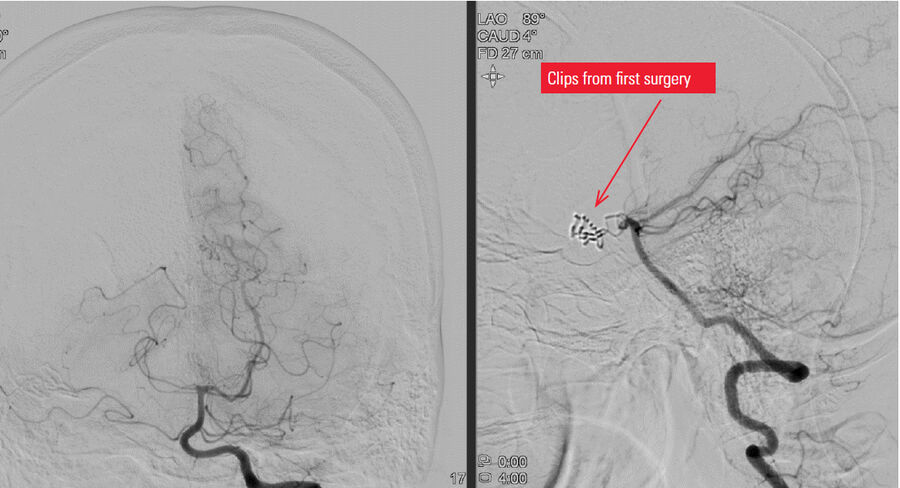 Showing the posterior circulation. Since we had a PCOM aneurysm to treat, we needed to know if the posterior circulation was dependent on the ICA (a persistent fetal circulation).