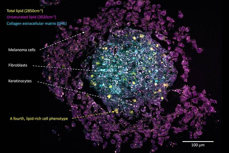 无标记SRS成像显示了多细胞皮肤癌球状体模型的核壳结构，展示了出乎意料的富脂细胞表型（分离的亮黄色细胞）的外观。 样本由德国曼海姆应用技术大学Julia Klicks博士和Rüdiger Rudolf教授提供。
