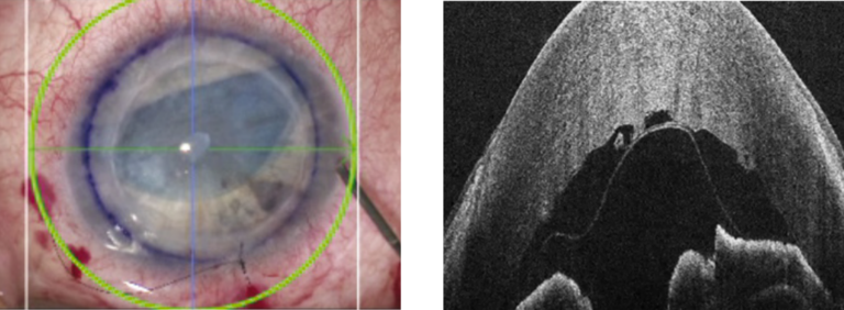 后弹力层角膜内皮移植术中的显微镜视图 (左)，辅以 EnFocus OCT 视图 (右)，显示供体膜的滚动方向。左侧显微镜图像致谢德国杜塞尔多夫大学医院眼科医学博士 Gerd Geerling (PhD、欧洲眼科委员会成员)