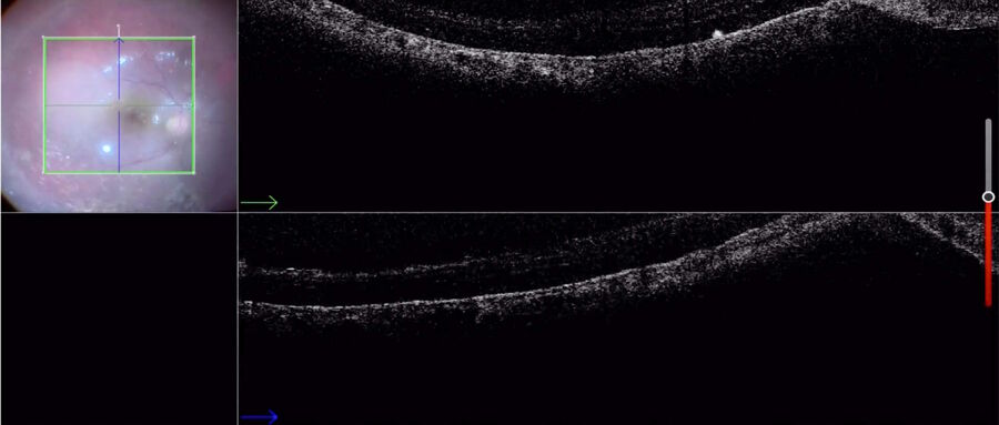 [Translate to chinese:] Vitrectomy for retinal detachment with use of PFCL shows attachment of the macula with PFCL.