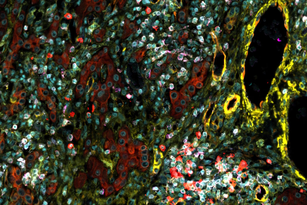 Hepatocellular Carcinoma with 13 biomarkers shown – Beta-Catenin, CD3D, CD4, CD8a, CD31, CD44, CD163, DAPI, PanCK, PCK26, PD1, SMA, and Vimentin. Hepatocellular_Carcinoma_13_Markers_Zoom2.jpg