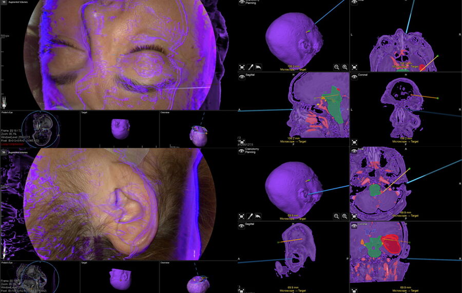 [Translate to chinese:] Registration accuracy check. Image courtesy of Prof. Philippe Bijlenga. 