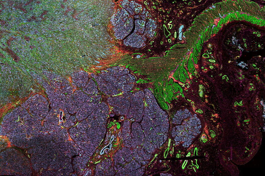 Pancreatic ductal adenocarcinoma tissue section imaged with Cell DIVE. 