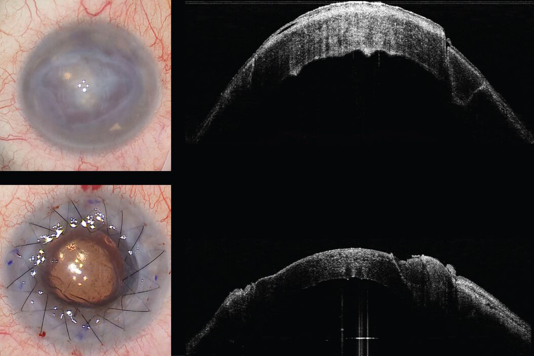 [Translate to chinese:] Keratoplasty of pathologic cornea Pathologic_cornea.jpg
