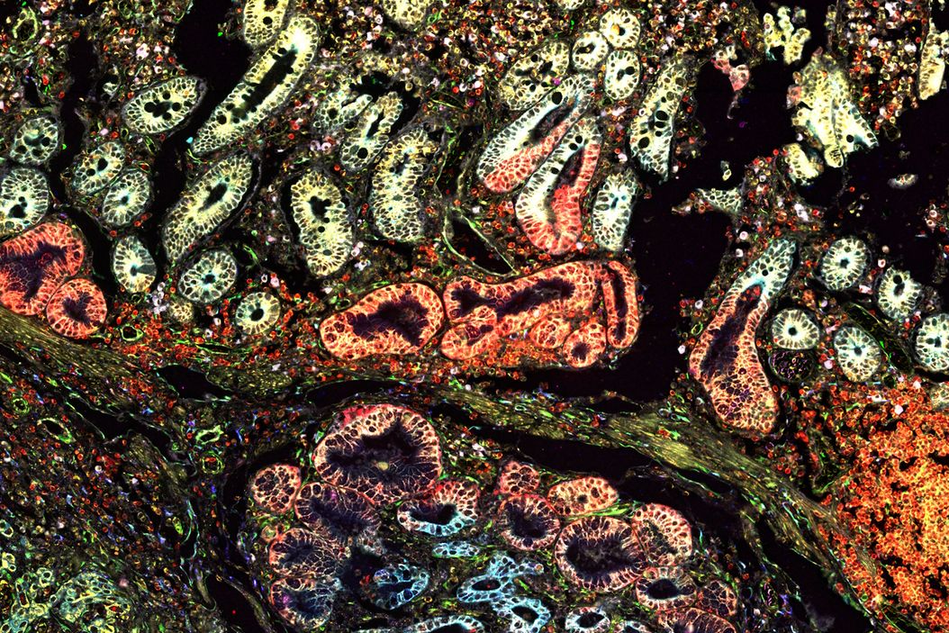 Pancreatic Ductal Adenocarcinoma with 11 Apoptosis biomarkers shown – BAK, BAX, BCL2, BCLXL, Caspase9, CIAP1, NaKATPase, PCK26, SMAC, Vimentin, and XIAP. Pancreatic_Ductal_Adenocarcinoma_11_Apoptosis_Markers_ROI5.jpg