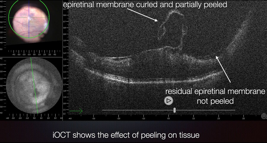 [Translate to chinese:] Checking the completeness of epiretinal membrane peeling with intraoperative OCT.