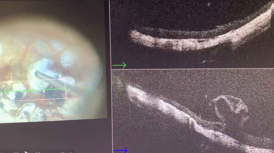 [Translate to chinese:] Vitrectomy and ILM peeling in a macular hole in a highly myopic eye.
