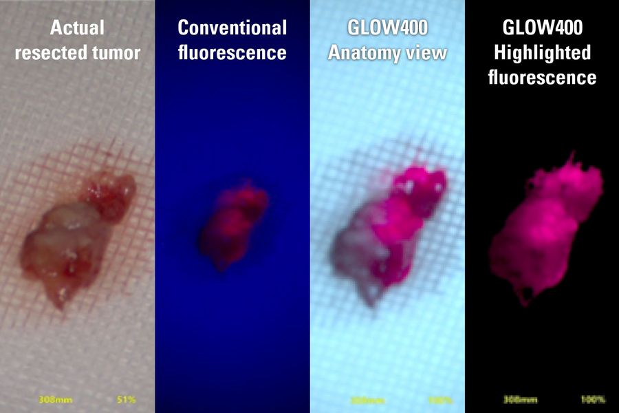 用 GLOW400 高亮荧光查看切除肿瘤的图像