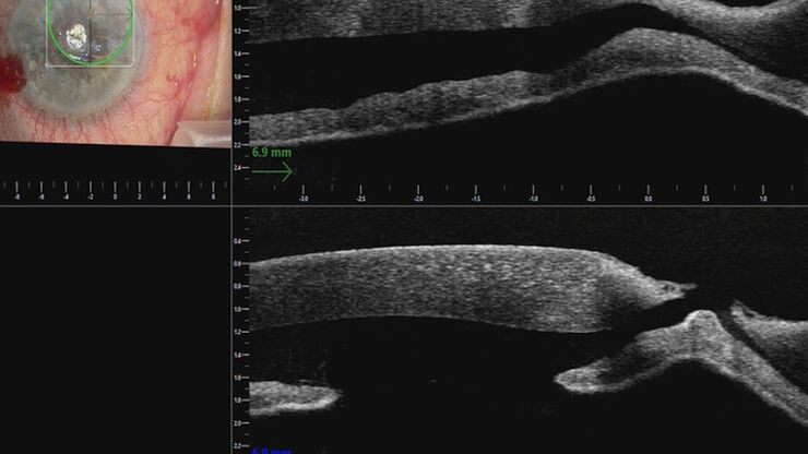 Corneal perforation with iris plugging shown on the intraoperative OCT. Images provided by Mr. David Anderson