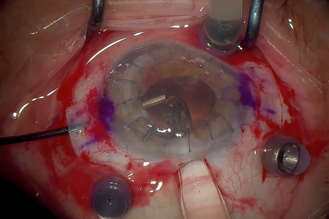 [Translate to chinese:] Intraoperative OCT-assisted complex cataract surgery. Image courtesy of Dr. Ozana Moraru.  Secondary_IOL_implantation_in_a_transplanted_eye_01.jpg