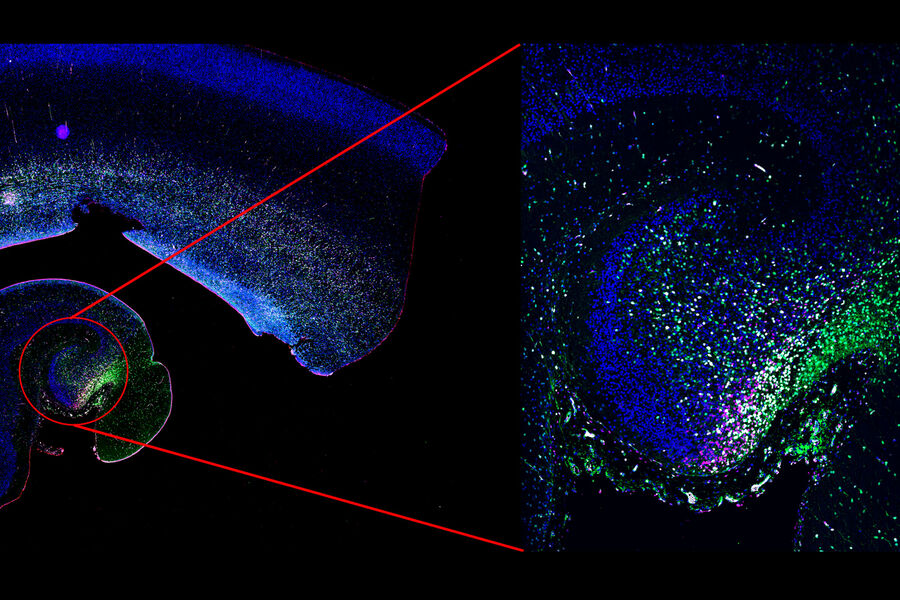 人类海马体。发育中的人脑内由Ki67（红色）、MCM2（品红色）和SOX2（绿色）标记的增殖神经元祖细胞。左图：宽场模式下采集的快速概览图。右图：共聚焦模式下的高分辨率扫描图像。图像由英国伦敦弗朗西斯·克里克研究所的博士生Piero Rigo提供。