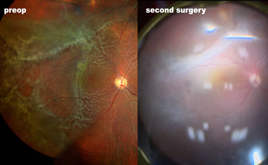[Translate to chinese:] A case of retinal detachment associated with congenital retinoschisis. The patient underwent two surgeries.