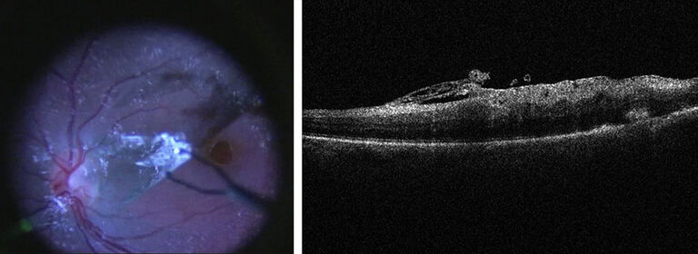 视网膜的显微镜视图 (左)，辅以 EnFocus OCT 视图 (右)，显示剥膜术中的膜层。OCT 图像致谢美国芝加哥医学博士 Seenu M. Hariprasad。