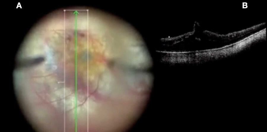 [Translate to chinese:] Vitrectomy and ILM peeling in macular hole in a high myopic eye.