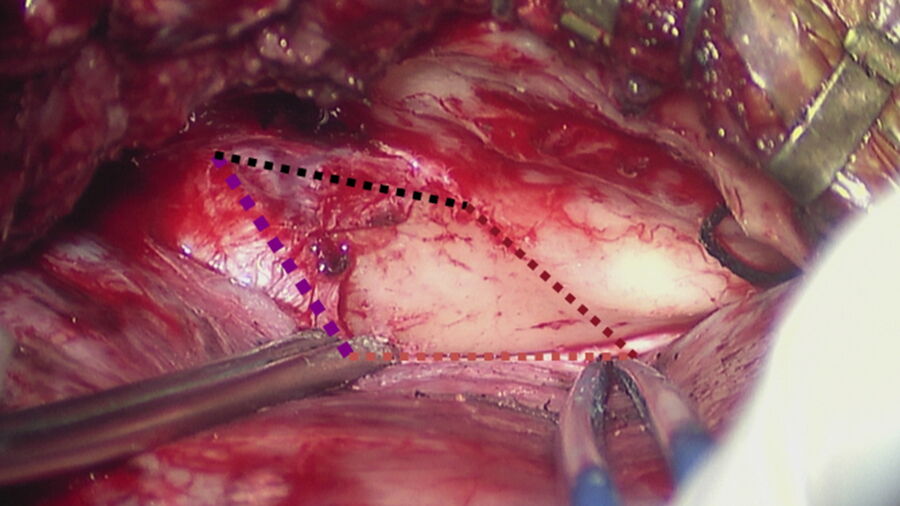 [Translate to chinese:] Lateral approach: anterior petrosectomy. Image courtesy of Prof. Roche.