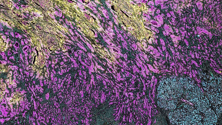 PDAC Multiplexed imaging of CST panels enables an examination of immune cell components in pancreatic ductal adenocarcinoma (IPDAC) tissue on a single slide.